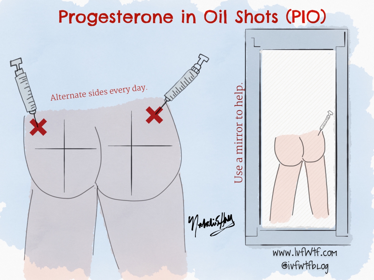 Progesterone in Oil (PIO)